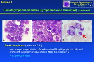 Hematolymphoid disorders (Lymphomas and leukemias)  (continued) Monomorphous population of medium sized Burkitt lymphoma cells with prominent cytoplasmic vacuolization. Note the mitosis in C. Burkitt lymphoma  (peritoneal fluid) A-C. Diff-Quik stain 62 