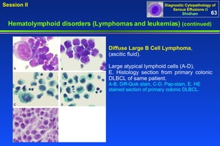 Hematolymphoid disorders (Lymphomas and leukemias)  (continued) Diffuse Large B Cell Lymphoma ,  (ascitic fluid).  Large atypical lymphoid cells (A-D).  E. Histology section from primary colonic DLBCL of same patient. A-B. Diff-Quik stain, C-D. Pap-stain, E. HE stained section of primary colonic DLBCL. 63 