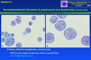 Hematolymphoid disorders (Lymphomas and leukemias)  (continued) HHV-8 associated lymphoma cells in ascitic fluid. Primary effusion lymphoma,  (ascitic fluid). A,B. Wright-Giemsa stain 64 