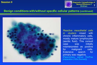 Benign conditions with/without specific cellular patterns  (continued) Reactive mesothelial cells in clusters  mixed with chronic inflammatory cells, mostly mature lymphocytes (ascitic fluid). This consult case was initially misinterpreted as positive for malignant cells. Extensive search for primary was negative. [Papanicolaou stained ThinPrep preparation (100x Zoomed)]. 7 