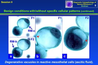 Benign conditions with/without specific cellular patterns  (continued) a b c RM-b RM-c F2 F1 F2 F1 Degenerative vacuoles in reactive mesothelial cells  (ascitic fluid).  8 