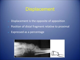 Partial Apposition Principles of Fractures. Principle of Fractures | PPT