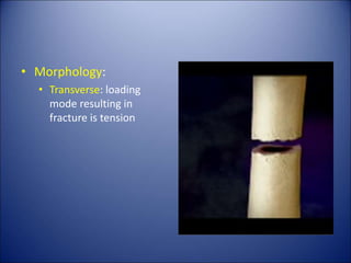 Principles of Fractures. Principle of Fractures | PPT