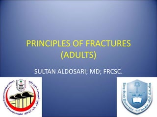 PRINCIPLES OF FRACTURES
(ADULTS)
SULTAN ALDOSARI; MD; FRCSC.
 