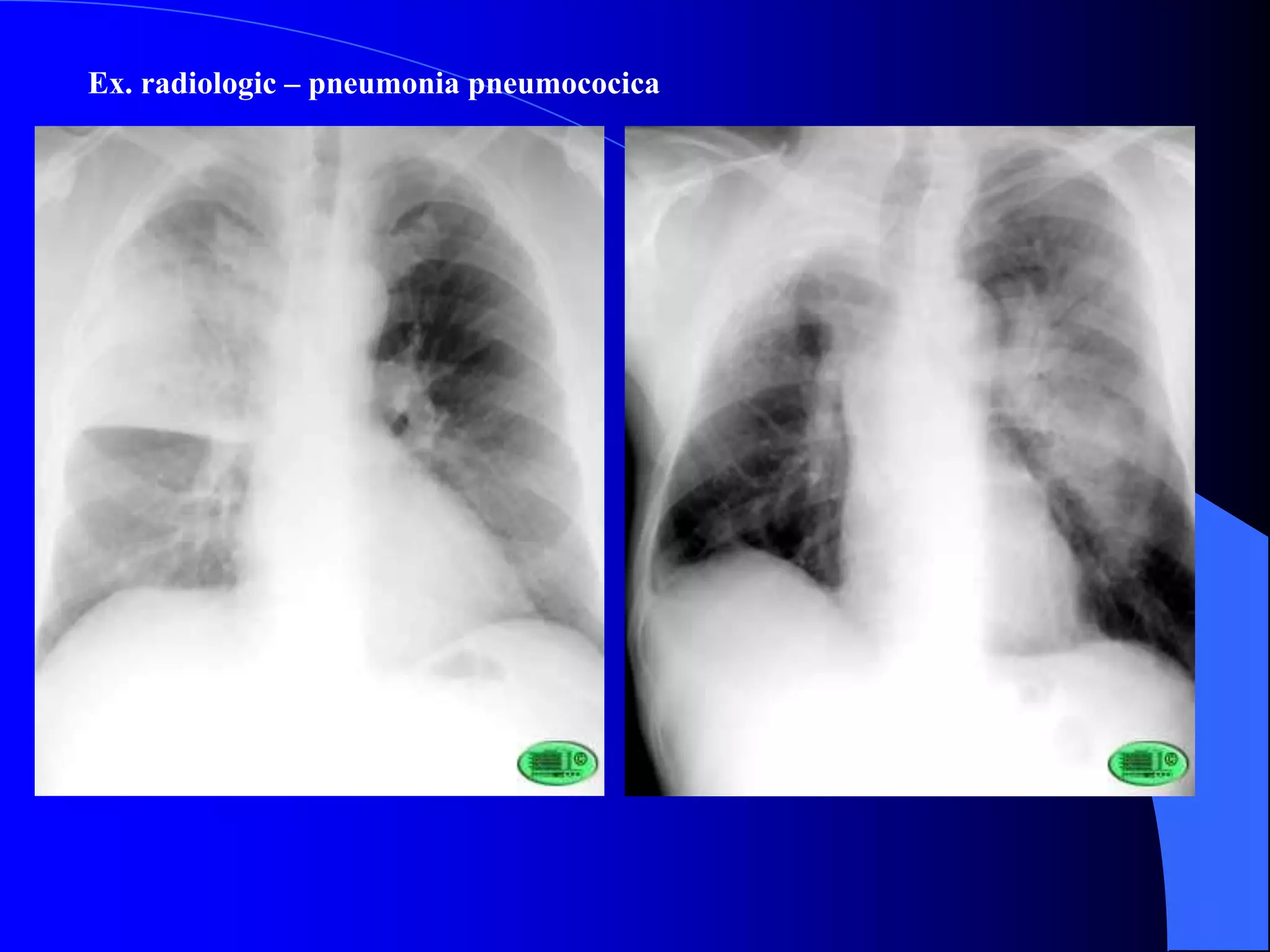 Ex. radiologic – pneumonia pneumococica
 