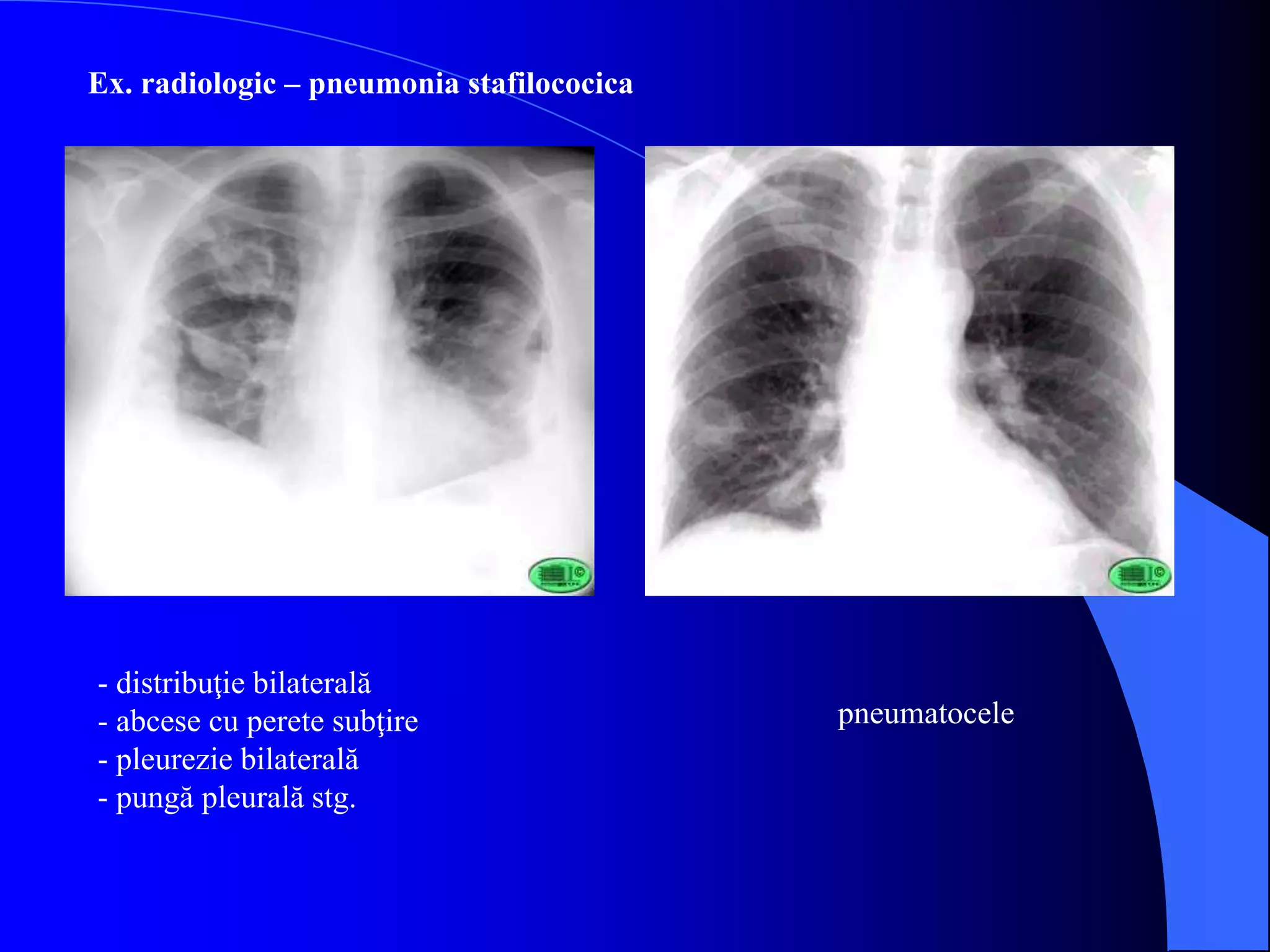 Ex. radiologic – pneumonia stafilococica
- distribuţie bilaterală
- abcese cu perete subţire
- pleurezie bilaterală
- pungă pleurală stg.
pneumatocele
 