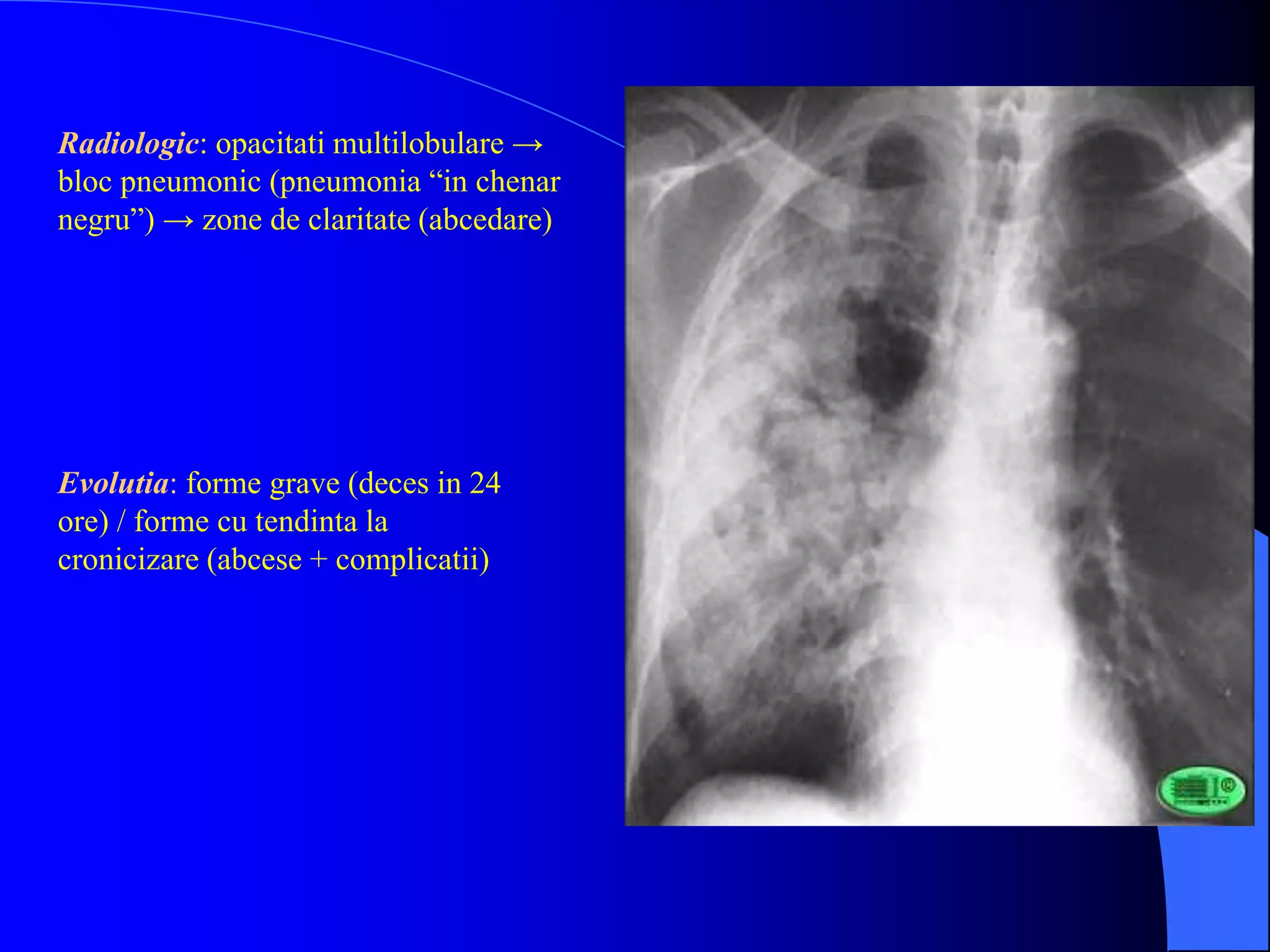 Radiologic: opacitati multilobulare →
bloc pneumonic (pneumonia “in chenar
negru”) → zone de claritate (abcedare)
Evolutia: forme grave (deces in 24
ore) / forme cu tendinta la
cronicizare (abcese + complicatii)
 