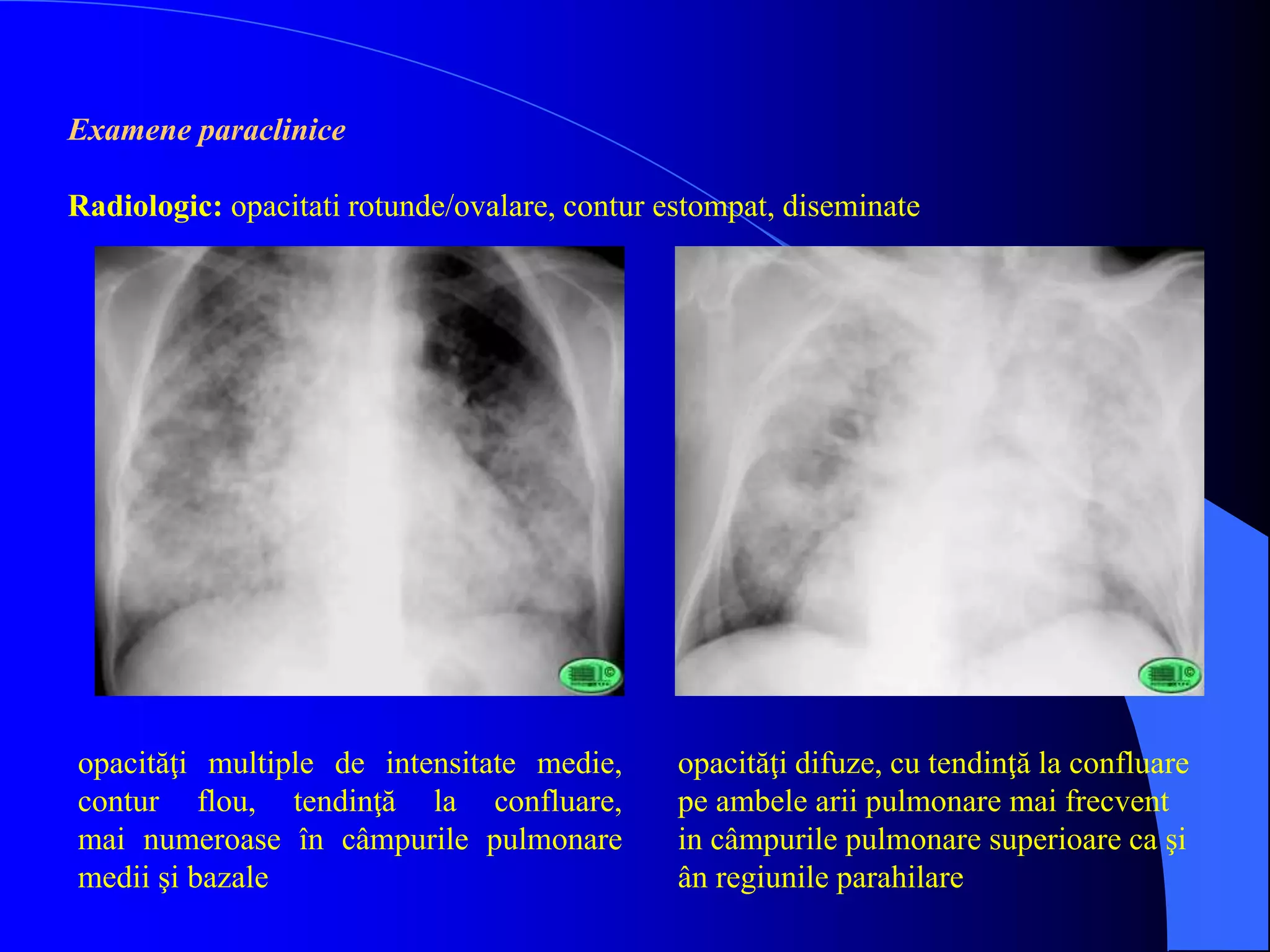 Examene paraclinice
Radiologic: opacitati rotunde/ovalare, contur estompat, diseminate
opacităţi multiple de intensitate medie,
contur flou, tendinţă la confluare,
mai numeroase în câmpurile pulmonare
medii şi bazale
opacităţi difuze, cu tendinţă la confluare
pe ambele arii pulmonare mai frecvent
in câmpurile pulmonare superioare ca şi
ân regiunile parahilare
 