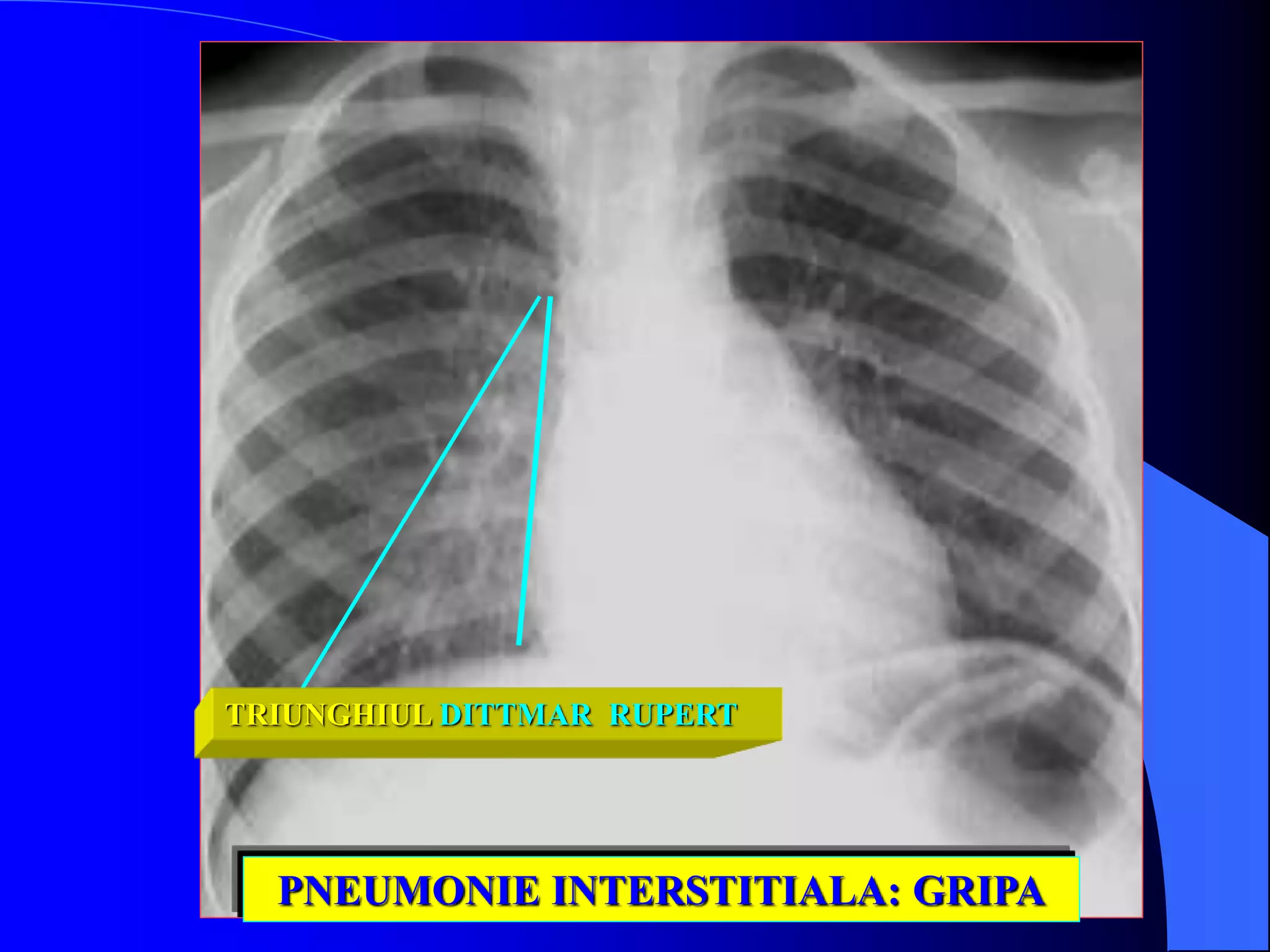PNEUMONIE INTERSTITIALA: GRIPA
TRIUNGHIUL DITTMAR RUPERT
 
