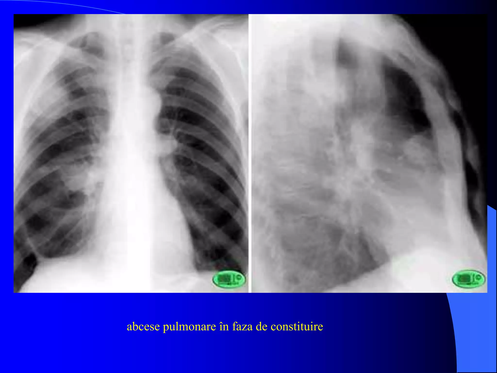 abcese pulmonare în faza de constituire
 