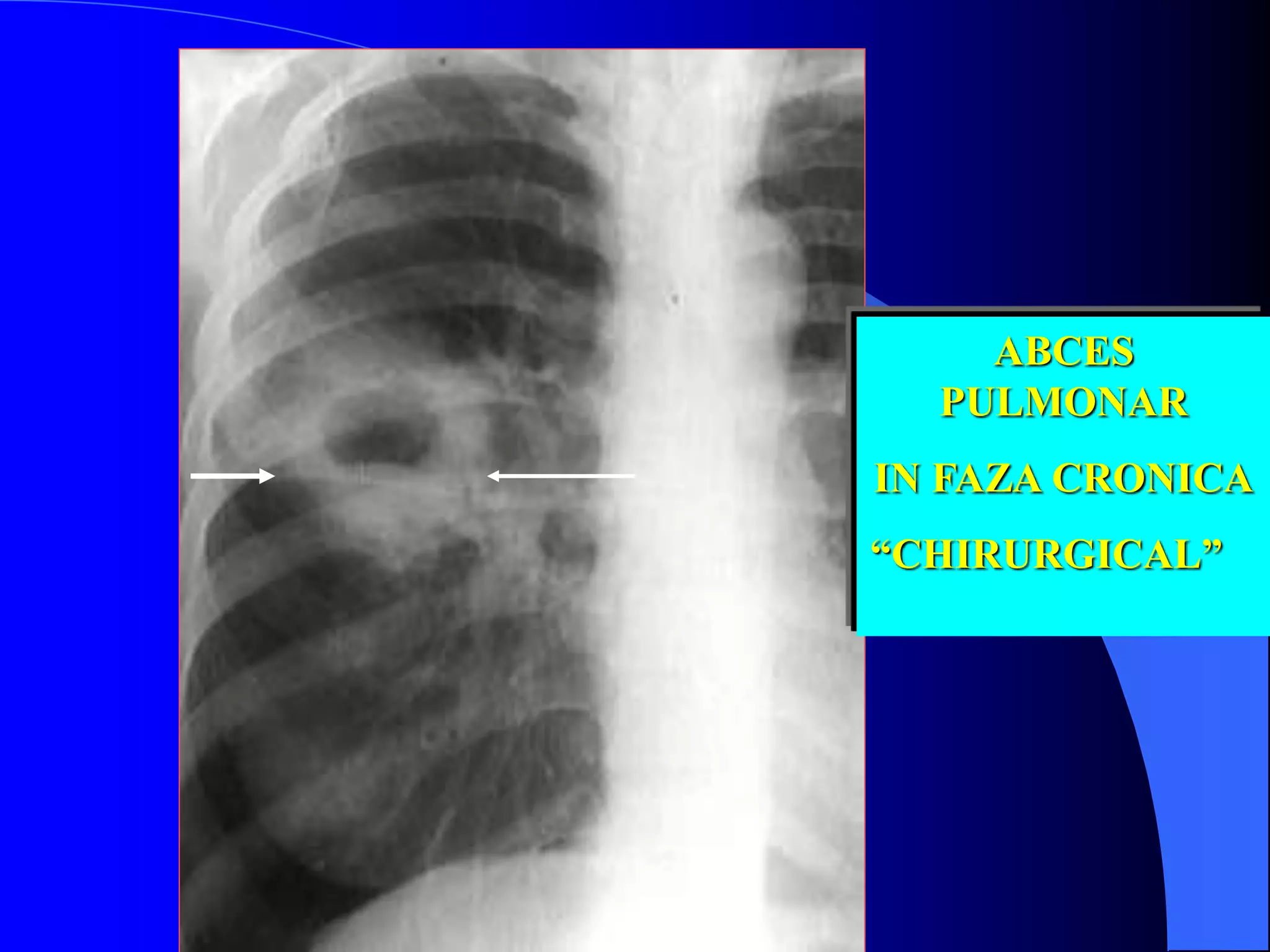 ABCES
PULMONAR
IN FAZA CRONICA
“CHIRURGICAL”
 