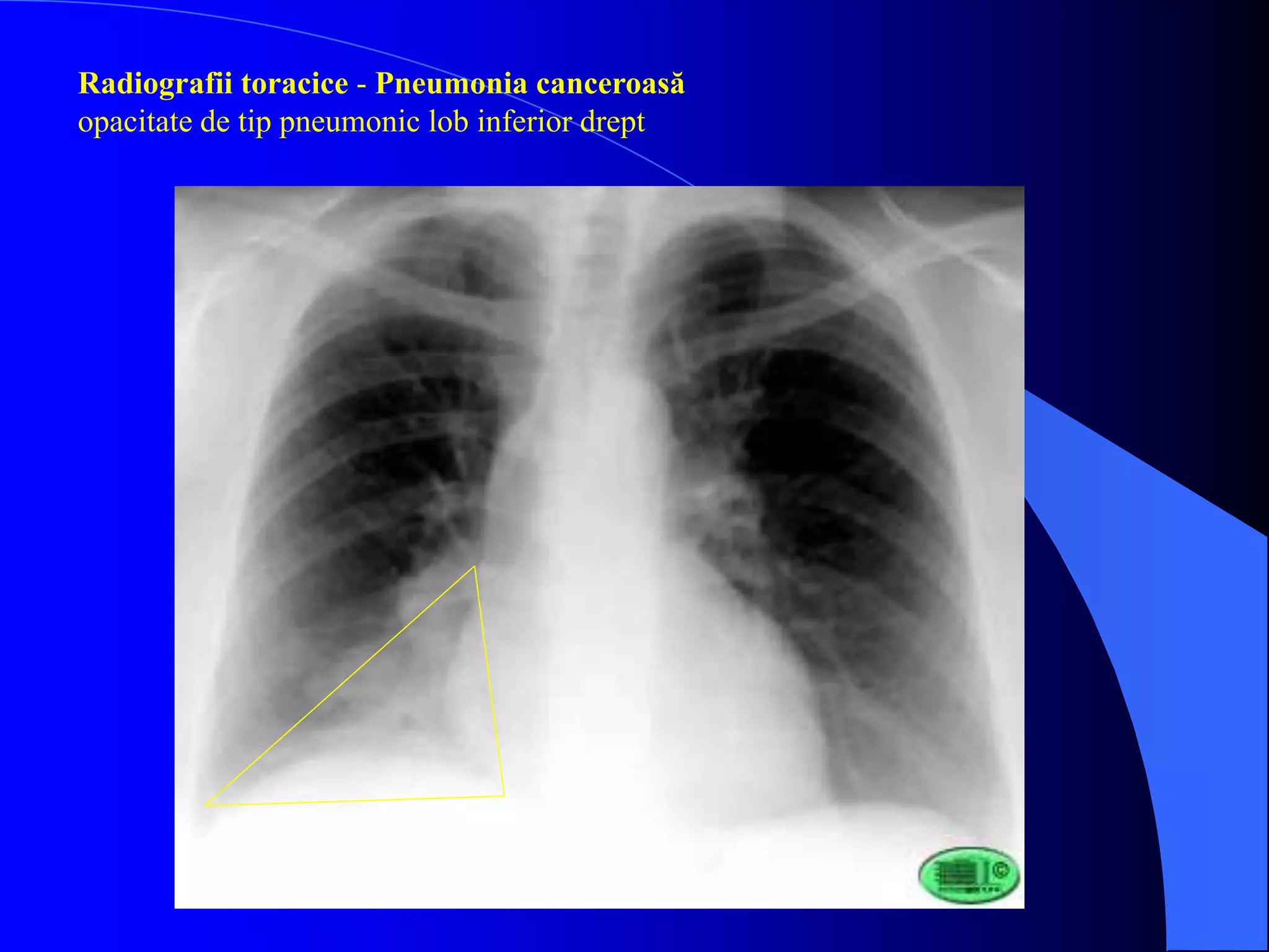 Radiografii toracice - Pneumonia canceroasă
opacitate de tip pneumonic lob inferior drept
 