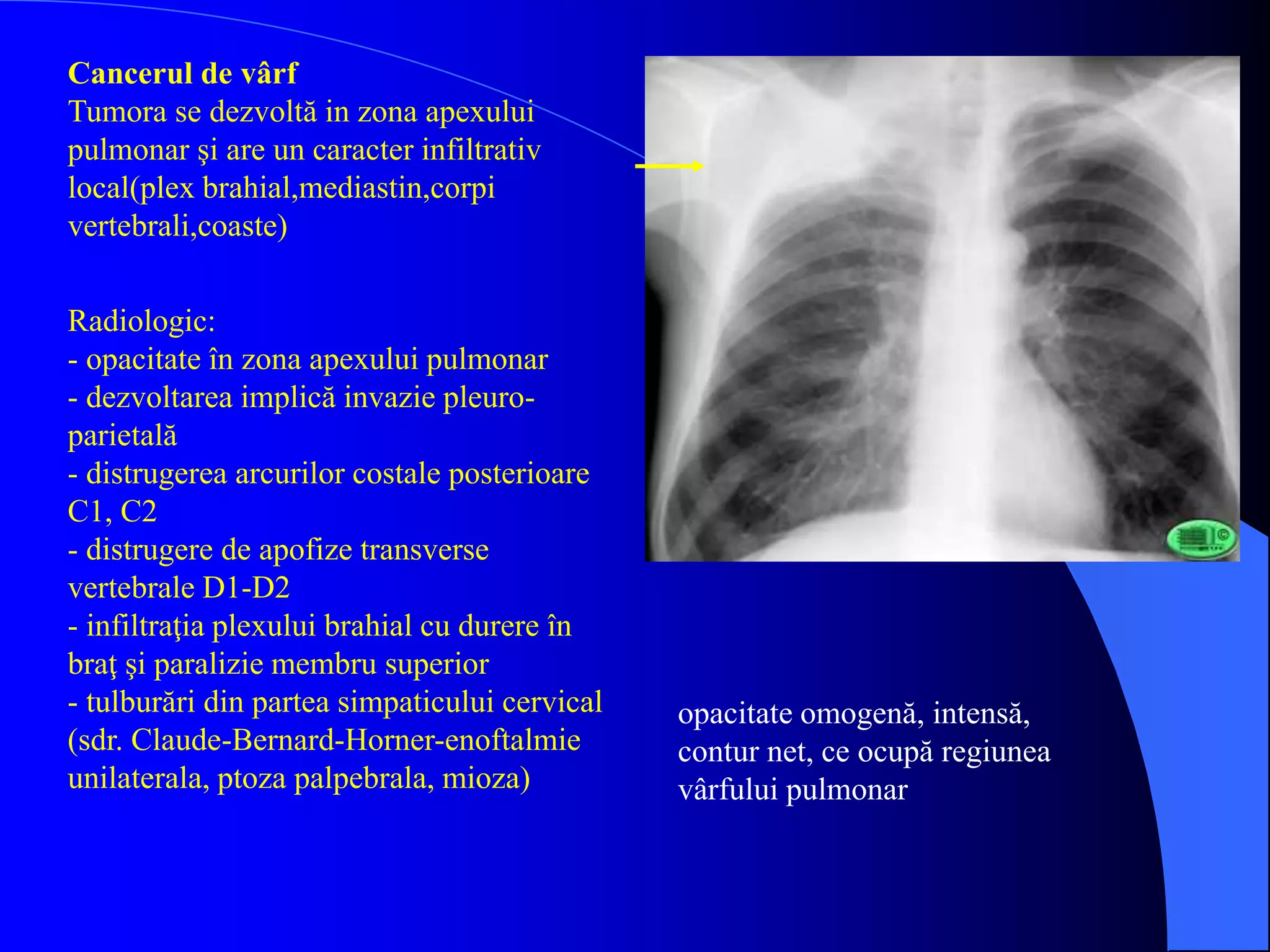 opacitate omogenă, intensă,
contur net, ce ocupă regiunea
vârfului pulmonar
Cancerul de vârf
Tumora se dezvoltă in zona apexului
pulmonar şi are un caracter infiltrativ
local(plex brahial,mediastin,corpi
vertebrali,coaste)
Radiologic:
- opacitate în zona apexului pulmonar
- dezvoltarea implică invazie pleuro-
parietală
- distrugerea arcurilor costale posterioare
C1, C2
- distrugere de apofize transverse
vertebrale D1-D2
- infiltraţia plexului brahial cu durere în
braţ şi paralizie membru superior
- tulburări din partea simpaticului cervical
(sdr. Claude-Bernard-Horner-enoftalmie
unilaterala, ptoza palpebrala, mioza)
 