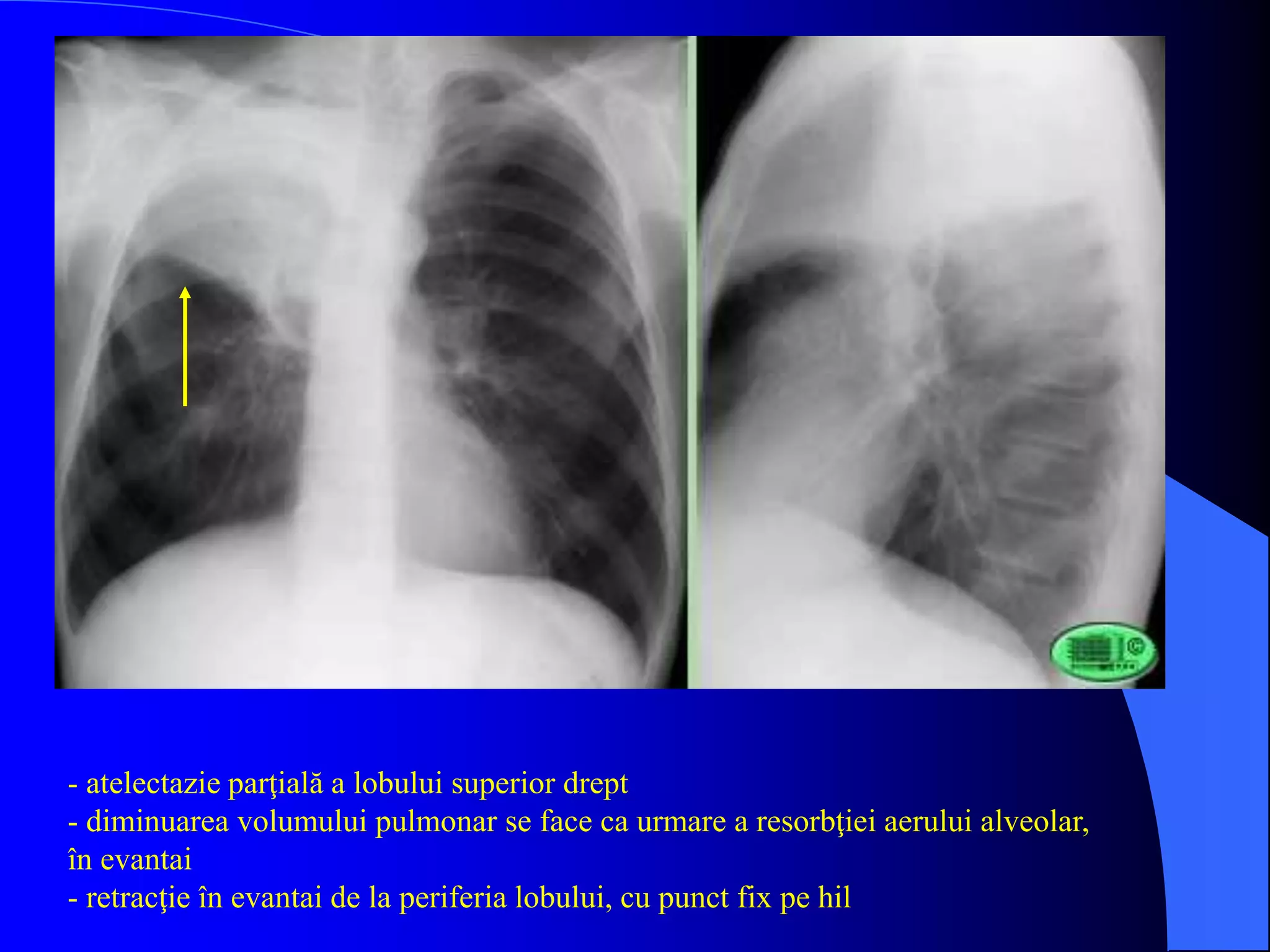 - atelectazie parţială a lobului superior drept
- diminuarea volumului pulmonar se face ca urmare a resorbţiei aerului alveolar,
în evantai
- retracţie în evantai de la periferia lobului, cu punct fix pe hil
 
