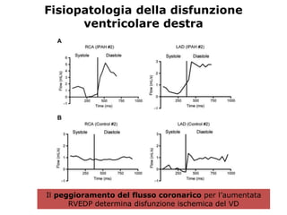 Fisiopatologia della disfunzione
ventricolare destra
Il peggioramento del flusso coronarico per l’aumentata
RVEDP determina disfunzione ischemica del VD
 