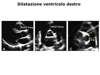 Dilatazione ventricolo destro
 