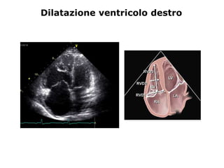 Dilatazione ventricolo destro
 