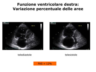 telediastole telesistole
FAS = 12%
Funzione ventricolare destra:
Variazione percentuale delle aree
 
