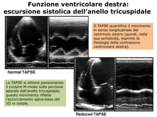 Il TAPSE quantifica il movimento
in senso longitudinale del
ventricolo destro (quindi, nella
sua semplicità, esprime la
fisiologia della contrazione
ventricolare destra).
La TAPSE si ottiene posizionando
il cursore M-mode sulla porzione
laterale dell’anello tricuspidale;
questo movimento riflette
l’accorciamento apice-base del
VD in sistole.
Funzione ventricolare destra:
escursione sistolica dell’anello tricuspidale
 