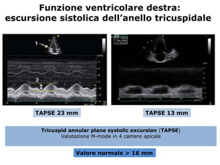 Tricuspid annular plane systolic excursion (TAPSE)
Valutazione M-mode in 4 camere apicale
Funzione ventricolare destra:
escursione sistolica dell’anello tricuspidale
Valore normale > 16 mm
TAPSE 23 mm TAPSE 13 mm
 