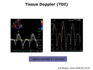 G B Bleeker, Heart 2006;92;19-26
Tissue Doppler (TDI)
Valore normale S’>10 cm/s
 