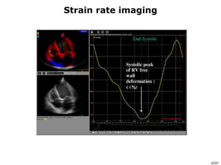 GC07
Strain rate imaging
 
