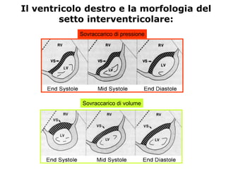 Il ventricolo destro e la morfologia del
setto interventricolare:
Sovraccarico di pressione
Sovraccarico di volume
 