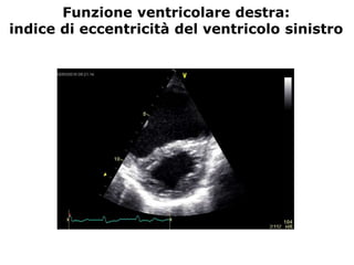 Funzione ventricolare destra:
indice di eccentricità del ventricolo sinistro
 