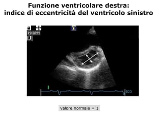 Funzione ventricolare destra:
indice di eccentricità del ventricolo sinistro
valore normale = 1
 