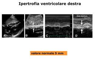Ipertrofia ventricolare destra
valore normale 5 mm
 