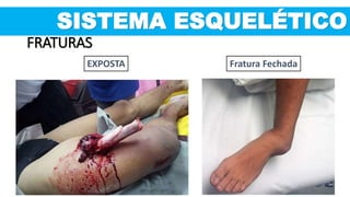 SISTEMA ESQUELÉTICO
FRATURAS
Fratura FechadaEXPOSTA
 