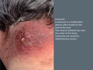 Back Carbuncle Comprehensive Overview of Clinical Bacteriology: Focus on Staphylococci ...