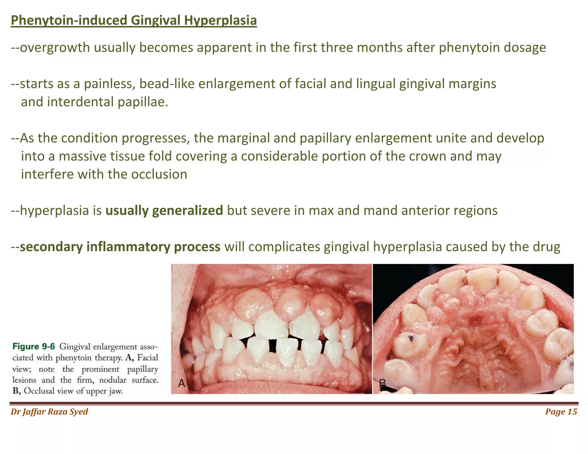 020.gingival enlargement | PDF, image size:2048x1582