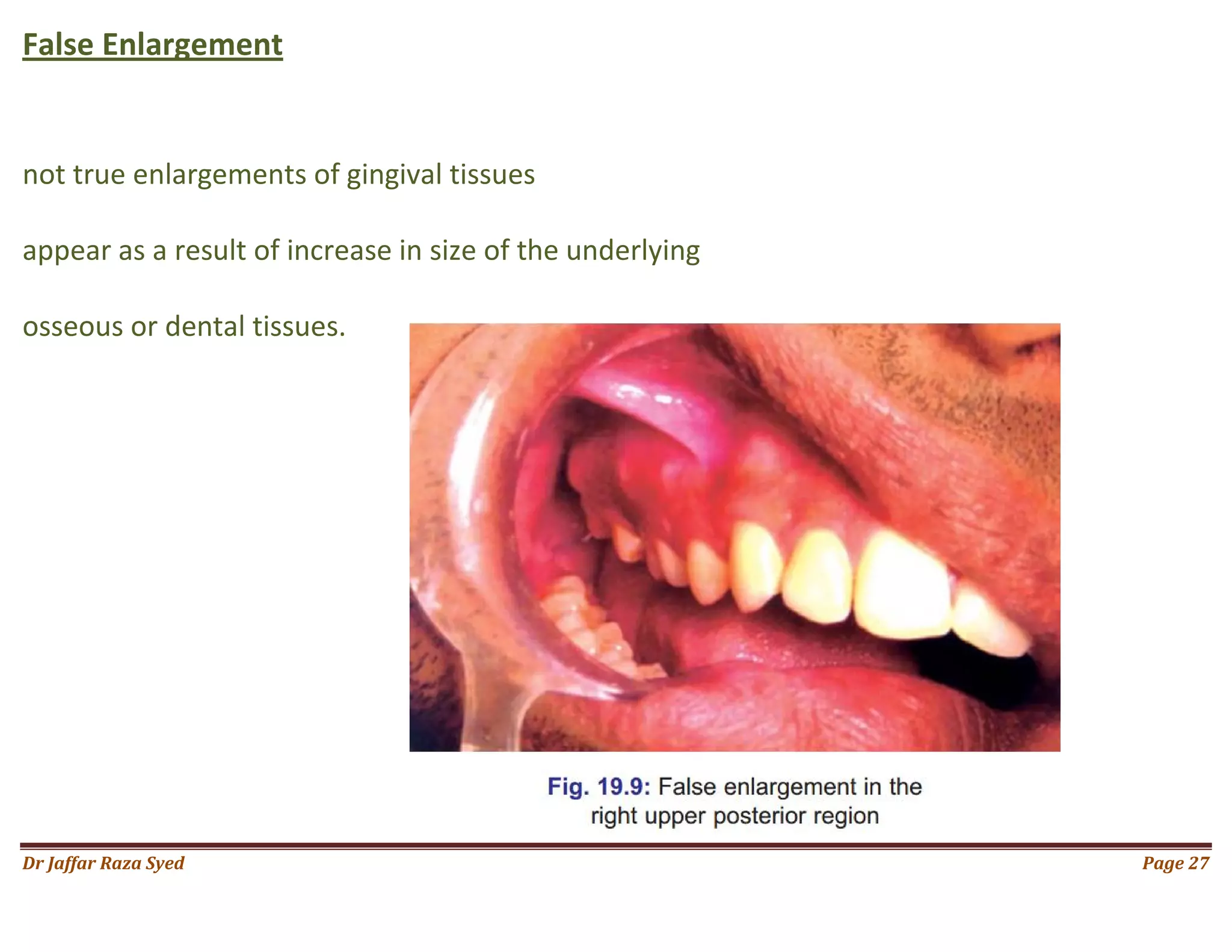 020.gingival enlargement | PDF, image size:2048x1582