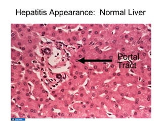 Hepatitis Appearance: Normal Liver
 