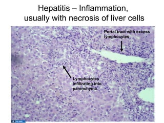 Hepatitis – Inflammation,
usually with necrosis of liver cells
                                  Portal tract with excess
                                  lymphocytes




              Lymphocytes
              infiltrating into
              parenchyma
 