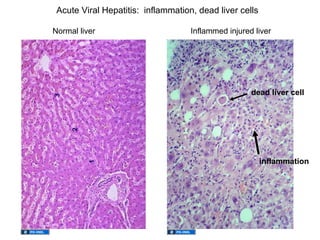 Acute Viral Hepatitis: inflammation, dead liver cells

Normal liver                        Inflammed injured liver




                                                     dead liver cell




                                                         inflammation
 