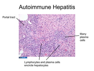 Autoimmune Hepatitis
Portal tract




                                               Many
                                               plasma
                                               cells




                Lymphocytes and plasma cells
                encircle hepatocytes
 