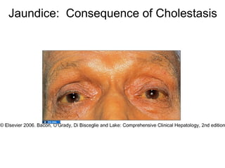 Jaundice: Consequence of Cholestasis
 
