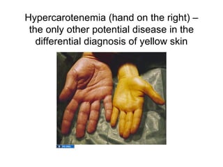 Hypercarotenemia (hand on the right) –
 the only other potential disease in the
   differential diagnosis of yellow skin
 