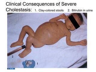 Clinical Consequences of Severe
Cholestasis: 1. Clay-colored stools 2. Bilirubin in urine
 