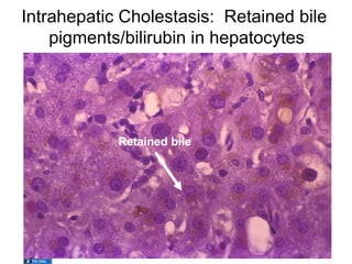 Intrahepatic Cholestasis: Retained bile
    pigments/bilirubin in hepatocytes




            Retained bile
 