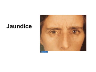 Jaundice
 