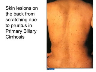 Skin lesions on
the back from
scratching due
to pruritus in
Primary Biliary
Cirrhosis
 