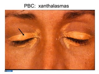 PBC: xanthalasmas
 