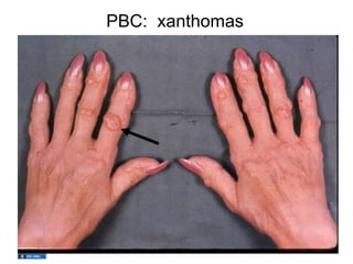 PBC: xanthomas
 