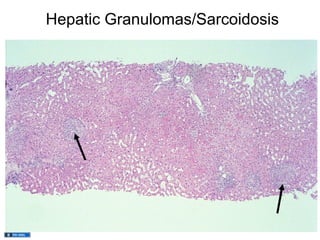 Hepatic Granulomas/Sarcoidosis
 