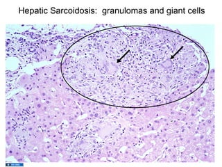 Hepatic Sarcoidosis: granulomas and giant cells
 