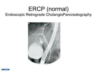 ERCP (normal)
Endoscopic Retrograde CholangioPancreatography
 