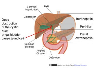 Common           Liver
                  hepatic duct


              Gallbladder
Does                                                                       Intrahepatic
obstruction
of the cystic                                                                    Perihilar
duct
or gallbladder                                                               Distal
cause jaundice?                                                           extrahepatic
                  Common
                  bile duct
                              Ampulla
                              Of Vater
                                         Duodenum


                                               Adapted from Gordon Flynn, Wikimedia Commons
 